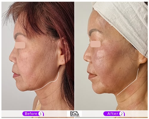 Hifu Treatment Sydney Your Ultimate Pathway To Ageless Beauty
