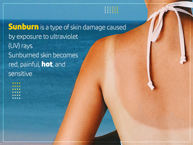 Get Sunburn Relief With Home Remedies for Pain & Inflammation
