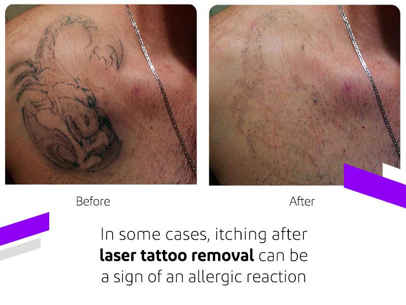 Pain Relief for Tattoo Removal