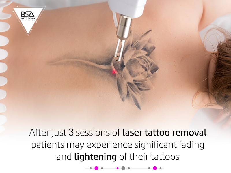 Before  After Photos of Sydney Laser Tattoo Removal Treatments