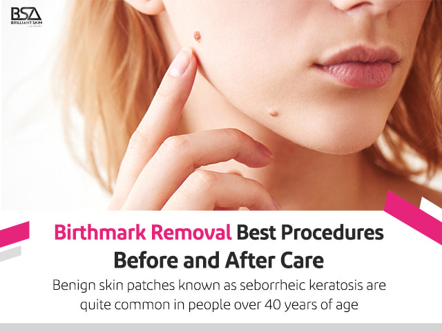 Removal of flesh birthmarks