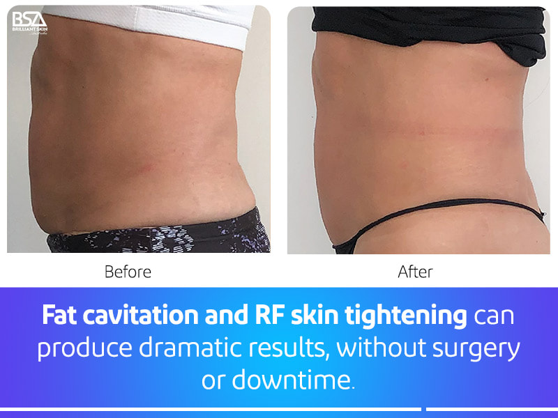 7 Best RF Cavitation ideas  ultrasonic cavitation, body contouring, radio  frequency skin tightening