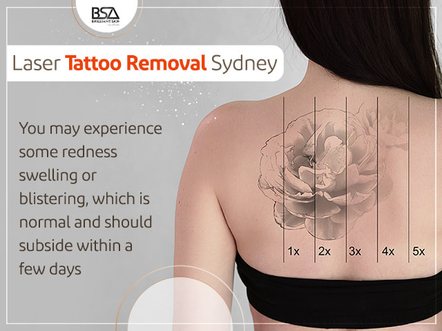 Sydney Laser Tattoo Removal | Cremorne Removery