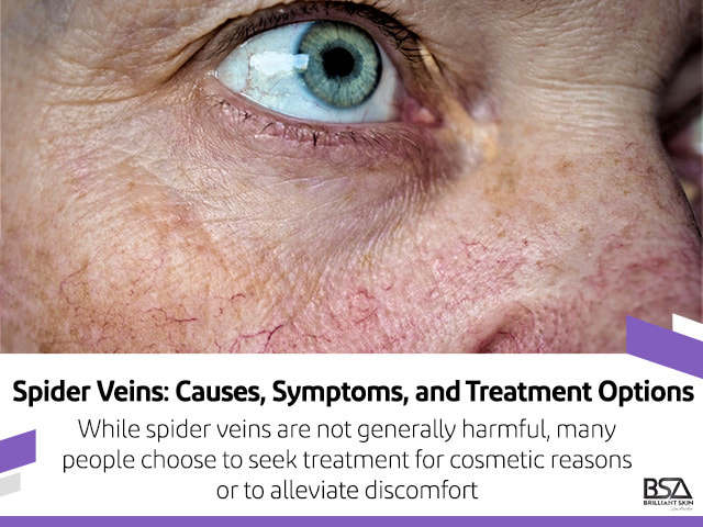 Treatment solutions for spider veins