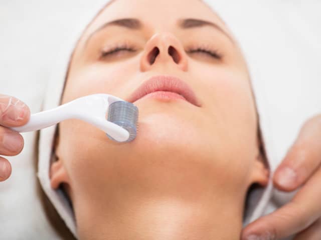 Microneedling