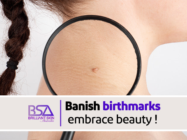 Professional Birthmark Removal Services